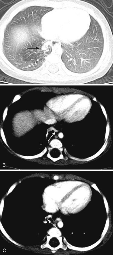 FIG 41-4, Intralobar sequestration. A, Contrast CT of chest in a 12-month-old reveals an airspace opacity in the posteromedial base of right lung (arrow). B, Axial CT also shows an obliquely coursing artery arising off the aorta, feeding this abnormal portion of lung (arrow). C, Another serpiginous contrast-enhancing structure arises from this portion and connects with a right inferior pulmonary vein (arrow). Findings suggest an intralobar sequestration.