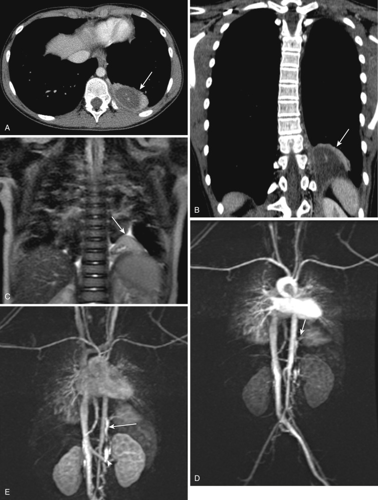 FIG 41-5, Extralobar sequestration. A, Axial CT shows a fluid-containing lesion in the left lower lobe adjacent to the diaphragmatic dome, consistent with extralobar pulmonary sequestration (arrow). B, Coronal CT in the same patient shows the fluid-containing lesion in the left lower lobe adjacent to the left dome of the diaphragm (arrow). C, T2-weighted coronal MRI in a 6-month-old boy shows a mass in the left lower lobe adjacent to the diaphragm; this suggests an extralobar sequestration (arrow). D, Coronal time-resolved MRA image shows arterial supply to this left lower lung mass arising directly from the upper abdominal aorta (arrow). E, Venous phase image from the same MRA shows the vertically coursing draining vein (arrow), which ultimately joins the left renal vein (arrowhead).