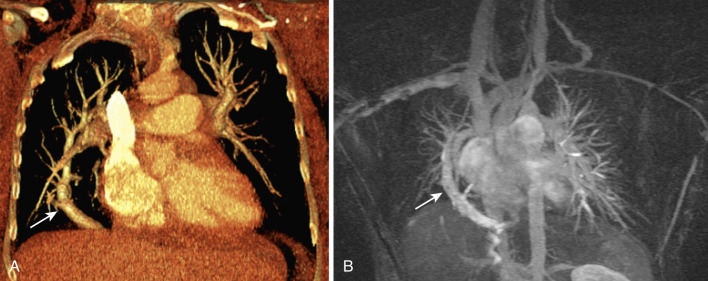 FIG 41-6, Scimitar syndrome. A, Coronal MIP image from a CT scan shows a large right pulmonary vein that is extending into the right lower lobe (arrow) parallel to the right heart border and extending below the diaphragm to drain into the inferior vena cava. The right lung is hypoplastic. B, Coronal MRA image in another patient shows an anomalous pulmonary vein (arrow) that is extending below the diaphragm to drain into the portal vein (not shown here) in this patient with scimitar syndrome.