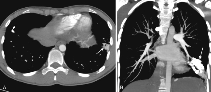 FIG 41-7, Pulmonary arteriovenous malformation. A, Axial CT shows an irregular enhancing mass in the periphery of the left lung (arrow) ; appearances consistent with arteriovenous malformation. B, Coronal MIP of the same patient demonstrates post-embolization appearances of this arteriovenous malformation (arrow).