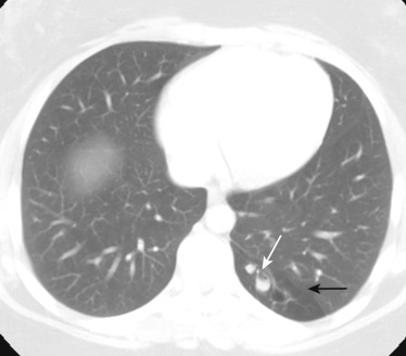 FIG 41-8, Bronchial atresia. Axial CT shows an area of mucoid plugging in the left lower lobe (white arrow), and distal to this there is an area of hyperlucency (black arrow), consistent with bronchial atresia.
