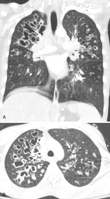 FIG 41-9, Cystic fibrosis. A, Coronal CT in a patient with cystic fibrosis shows extensive cystic bronchiectatic changes predominantly seen in the upper lobes, along with bronchial thickening. The lungs are hyperinflated. B, Axial CT in the same patient shows extensive bilateral upper lobe–predominant bronchiectatic changes along with bronchial thickening and areas of mucoid plugging.