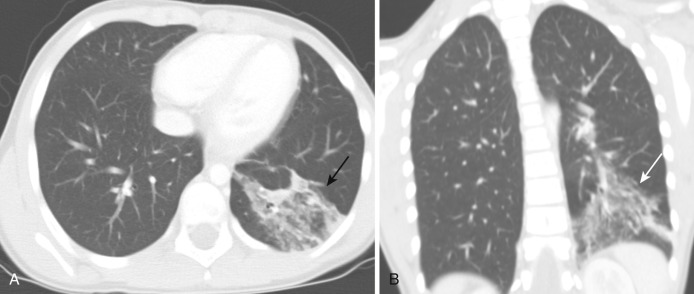 FIG 41-10, Pneumonia. A, Axial CT shows an area of consolidation with air bronchogram in the left lower lobe (arrow) consistent with pneumonia. B, Coronal CT in the same patient shows the consolidation with air bronchogram in the left lower lobe.