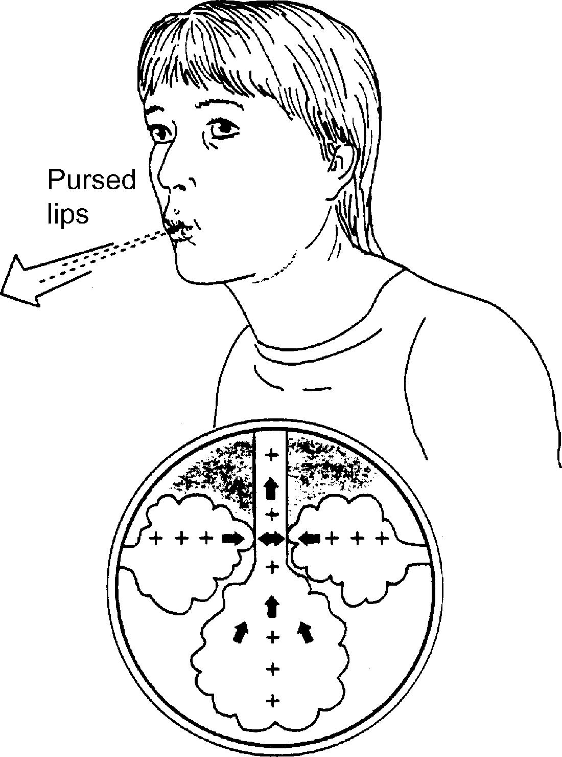 Fig. 11.3, Demonstration of pursed-lip breathing in patients with COPD and its effects. The weakened bronchial airways are kept open by the effects of positive pressure created by pursed lips during expiration.