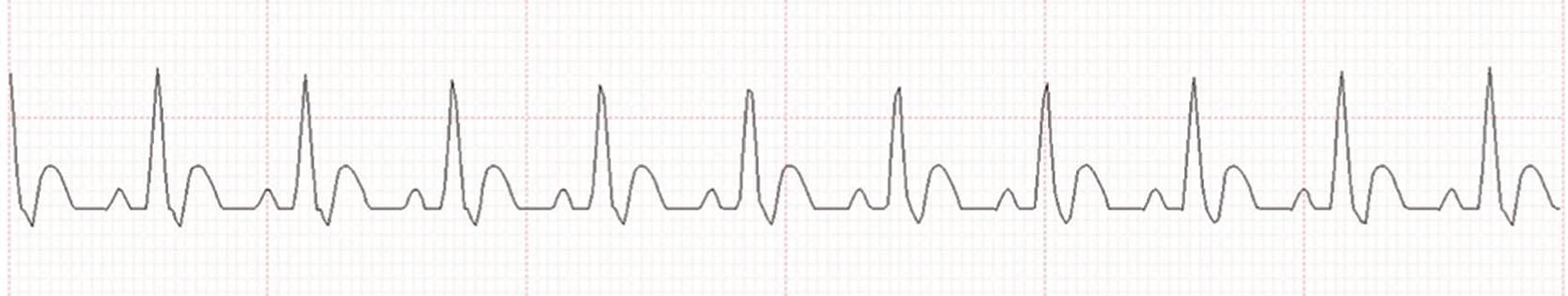 Fig. 1.1, Telemetry strip showing lead ii with a heart rate of 105 bpm, and sinus rhythm