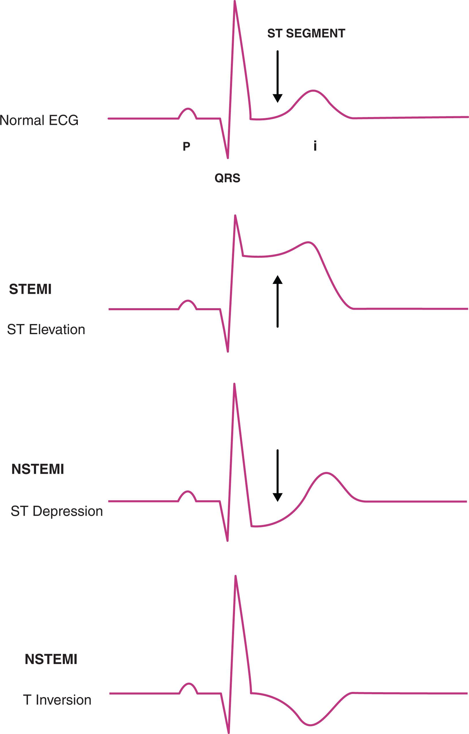 Fig. 2.1, A , EKG tracings showing different morphologies of ST-segment in different forms of ACS. B , EKG tracing showing ST-segment elevations in V1-V4, and ST depressions in leads I, aVL.