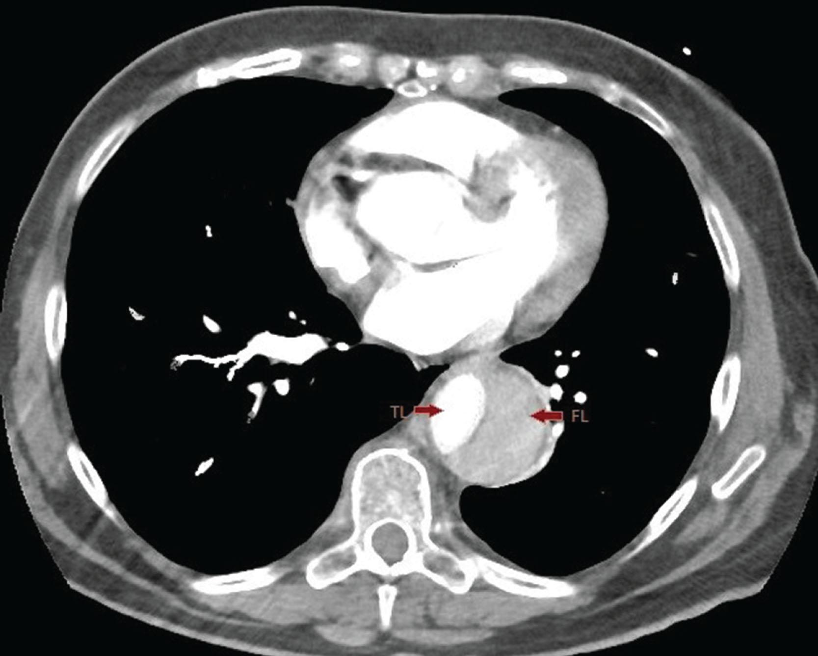 Fig. 3.1, CT angiogram of the chest showing an intimal tear in the descending thoracic aorta and formation of false lumen separated from the true lumen by an intimal flap.