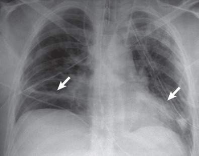 Fig. 69.1, Linear (discoid) subsegmental atelectasis. Anteroposterior chest radiograph shows multiple tubes and lines and bibasilar discoid opacities (arrows) with vascular crowding consistent with subsegmental atelectasis.