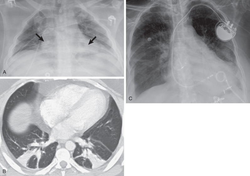 Fig. 69.2, Subsegmental atelectasis. (A) Anteroposterior (AP) chest radiograph shows low lung volumes and bibasilar ill-defined opacities (arrows). (B) CT scan of the lower chest shows bilateral-dependent lower lobe band-like opacities with bronchovascular crowding indicating atelectasis. (C) AP chest radiograph in a different patient demonstrates retrocardiac segmental crowding of air bronchograms resulting from left lower lobe atelectasis.