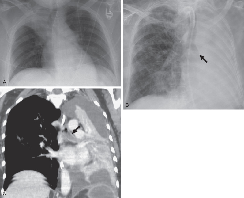 Fig. 69.3, Lobar/multilobar atelectasis. (A) Anteroposterior (AP) chest radiograph shows a homogeneous right upper lung zone opacity with rightward tracheal deviation and elevation of the minor fissure, characteristic of right upper lobe atelectasis. (B) AP chest radiograph shows complete opacification of the left hemithorax, leftward mediastinal shift, and abrupt truncation of the left main bronchus (arrow). (C) Contrast-enhanced coronal reformatted CT scan of the chest shows enhancing atelectatic left lung, pleural effusion, volume loss, and the left main bronchus filled with mucus (arrow).