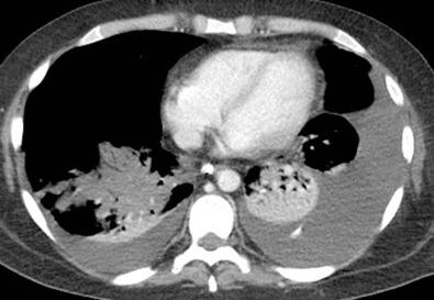 Fig. 69.4, Enhancing atelectasis. CT scan of the chest demonstrates enhancement within the left lower lobe consistent with atelectasis. Nonenhancing right lung is secondary to necrotizing pneumonia. Moderate left and small right pleural effusions are also present.
