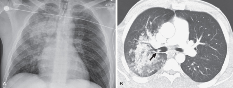 Fig. 69.5, Aspiration, consolidative pattern. (A) Anteroposterior chest radiograph shows right upper lung zone consolidation. (B) CT scan shows right upper lobe posterior segmental consolidation and centrilobular nodules. Note aspirated debris in the right upper lobe bronchus (arrow).