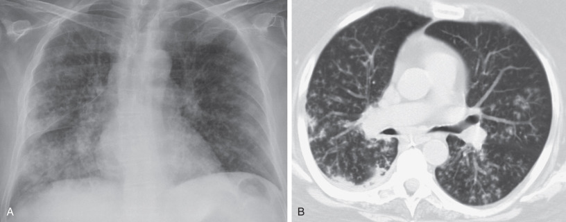 Fig. 69.6, Aspiration, tree-in-bud pattern. (A) Anteroposterior chest radiograph shows bilateral 3- to 5-mm ill-defined nodular opacities. (B) CT scan of chest shows predominantly posterior bilateral nodules with tree-in-bud opacities.