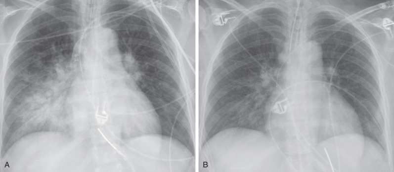 Fig. 69.7, Aspiration pneumonitis, temporal change. (A) Anteroposterior (AP) chest radiograph shows right perihilar and lower lung zone consolidation. (B) AP chest radiograph 2 days later shows marked improvement.