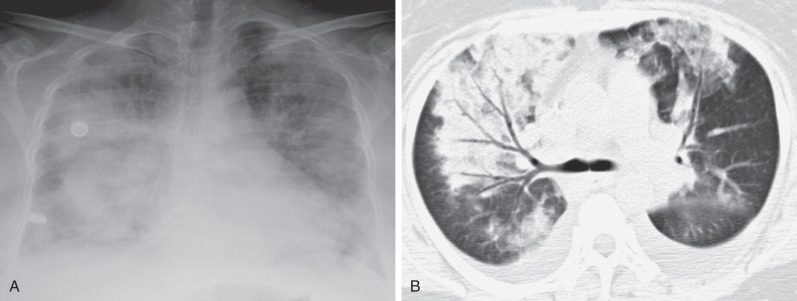 Fig. 69.8, Multifocal bacterial bronchopneumonia. (A) Anteroposterior chest radiograph shows multifocal dense consolidation, worse on the right. (B) CT scan confirms bilateral and asymmetric distribution of consolidation and air bronchograms. Bilateral pleural effusions also are noted.