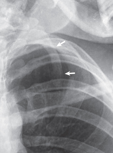 Fig. 79.1, Cervical rib. Close-up view from chest radiograph shows a supernumerary bone (arrows) arising from the left side of the seventh cervical vertebra.