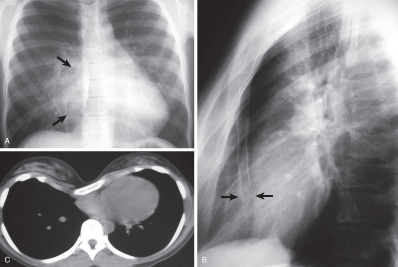 Fig. 79.4, Pectus excavatum. (A) Posteroanterior chest radiograph shows obscuration of the right heart border (arrows) and displacement of the heart to the left. (B) Lateral chest radiograph shows posterior displacement of the sternum (arrows). (C) CT scan shows severe pectus excavatum with compression of the lungs and displacement of the heart to the left.