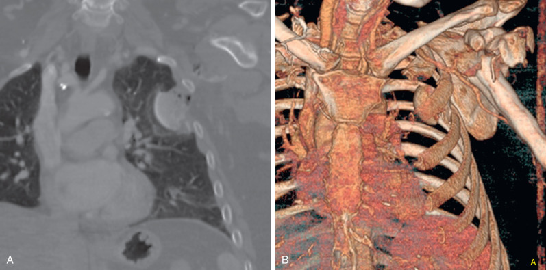 Fig. 79.5, Intrathoracic humeral head fracture and dislocation after chest wall trauma. Coronal chest CT scan (A) and three-dimensional reformatted image (B) show an intrathoracic dislocation of a portion of the fractured left humeral head.