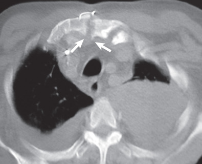 Fig. 79.6, Sternal dehiscence and infection from Staphylococcus aureus after coronary artery bypass graft surgery. CT image shows sternal dehiscence (arrows). Bilateral pleural effusions are also noted.