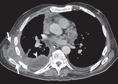 Fig. 79.8, Empyema necessitatis from tuberculosis. Contrast-enhanced CT scan shows a right pleural effusion (arrowhead) and a lentiform right chest wall lesion showing central low attenuation (arrows) consistent with focal tuberculous chest wall abscess.