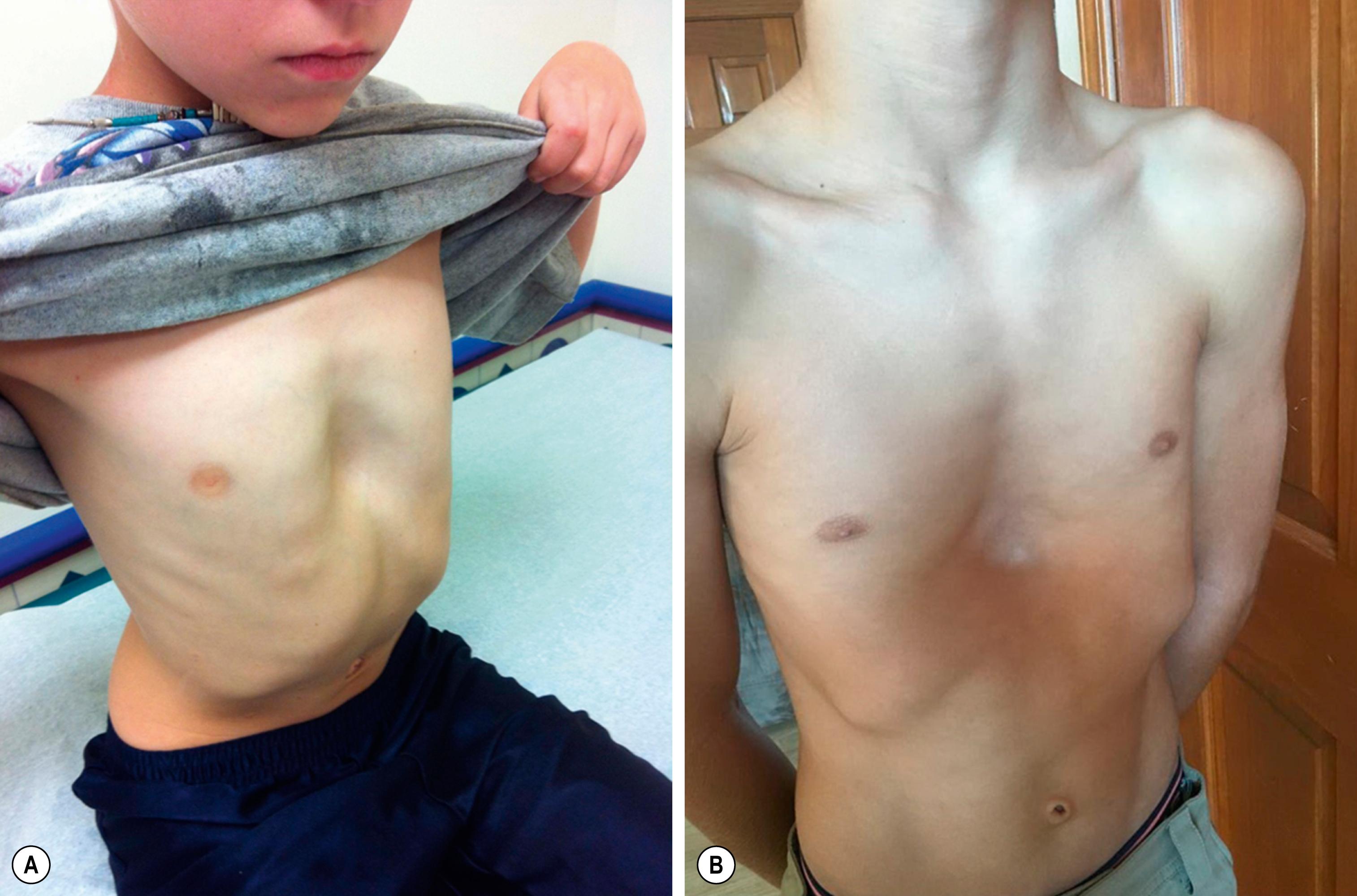 Fig. 20.1, (A) The typical focal or “cup-shaped” pectus excavatum deformity. (B) A wider, more diffuse or “saucer-shaped” deformity.