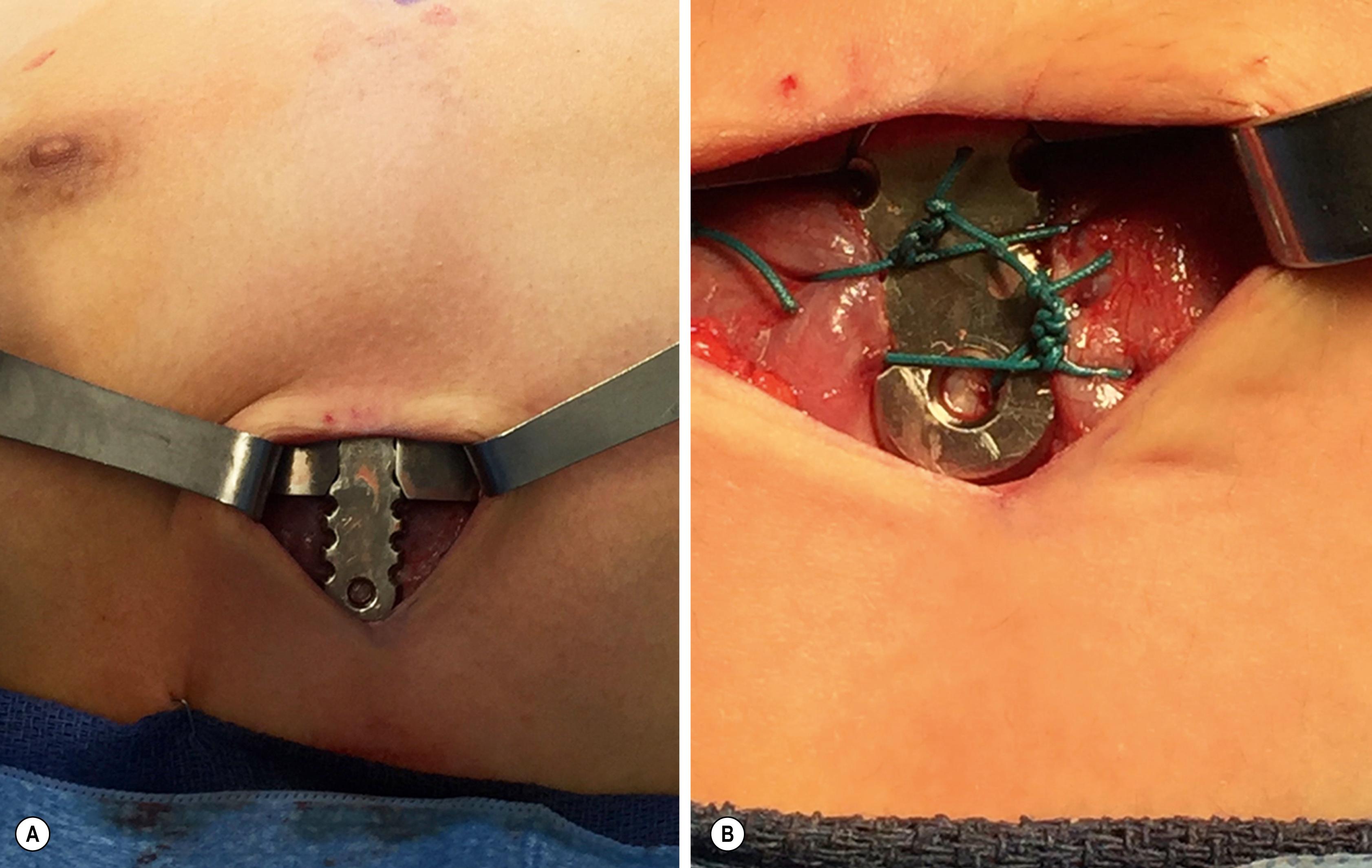 Fig. 20.11, These two photographs depict the stabilizer used to secure the bar along the lateral chest wall. On the left (A) the bar has been engaged in the stabilizer. On the right (B) the stabilizer has been secured by sutures placed around the ribs. In addition, sutures had been placed in the two holes in the stabilizer to further secure the stabilizer and the bar to the lateral chest wall.