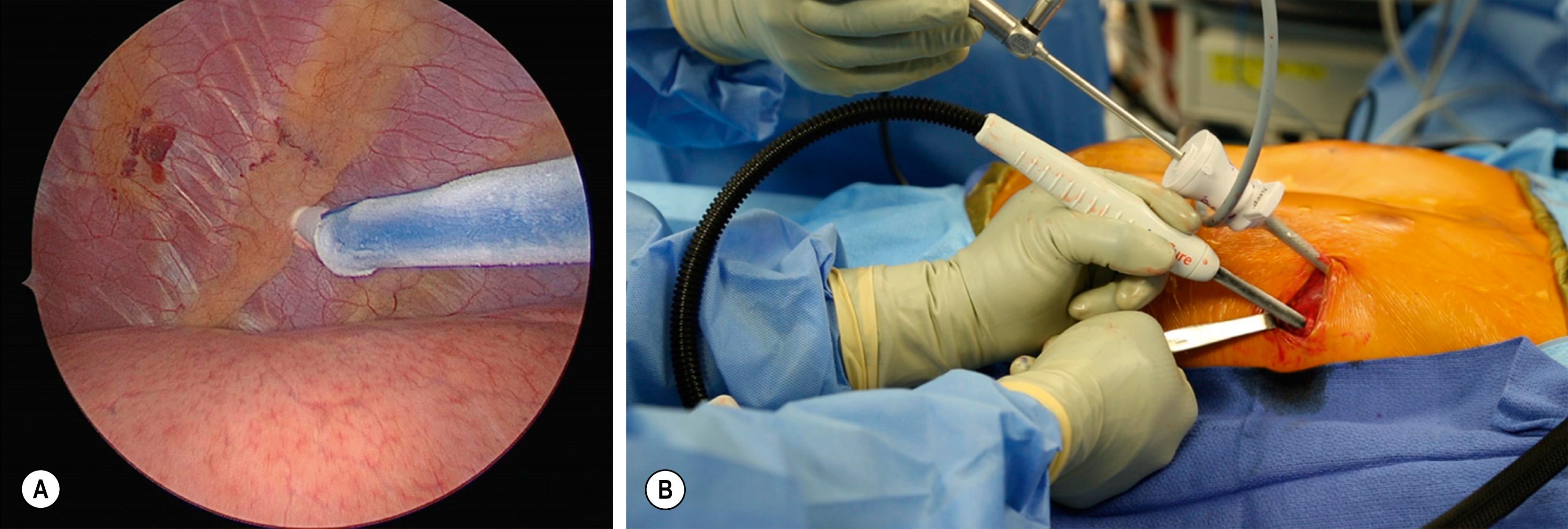 Fig. 20.12, The use of cryoablation is a new technique to reduce/eliminate pain in the postoperative period. On the left (A) the cryoablation probe is being applied to the intercostal nerve bundle below the third rib on the right side. It takes approximately 2 minutes to cryoablate each intercostal bundle. Note the ice forming along the cryoablation probe. On the right (B) the probe has been inserted into the right chest through the lateral chest wall incision. Note the cannula and telescope that have been introduced into the right thoracic cavity through the same lateral chest wall incision. It is important to retract the inferior aspect of the incision so as not to cryoablate the skin as well.