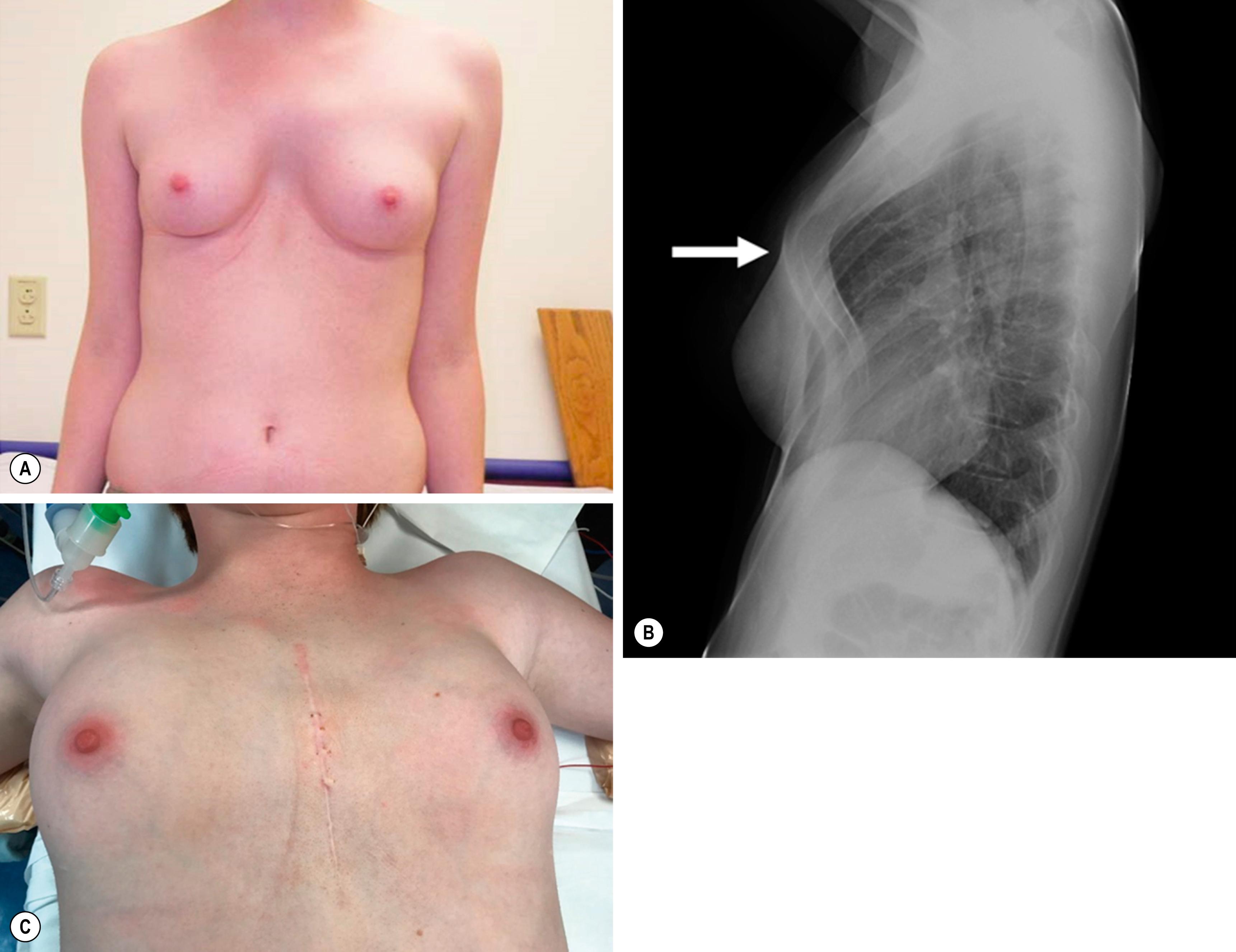 Fig. 20.13, This girl has the typical features of Currarino–Silverman syndrome (A). It looks like she has a pectus excavatum, but she really has a variant of pectus carinatum. The sternum is short, and there is marked posterior angulation (arrow) at the site of the normal chondromanubrial junction (B). The photograph in (C) was taken 18 months postoperatively at the time of removal of the substernal bar that was placed at the time of her initial operation (Ravitch-type repair).