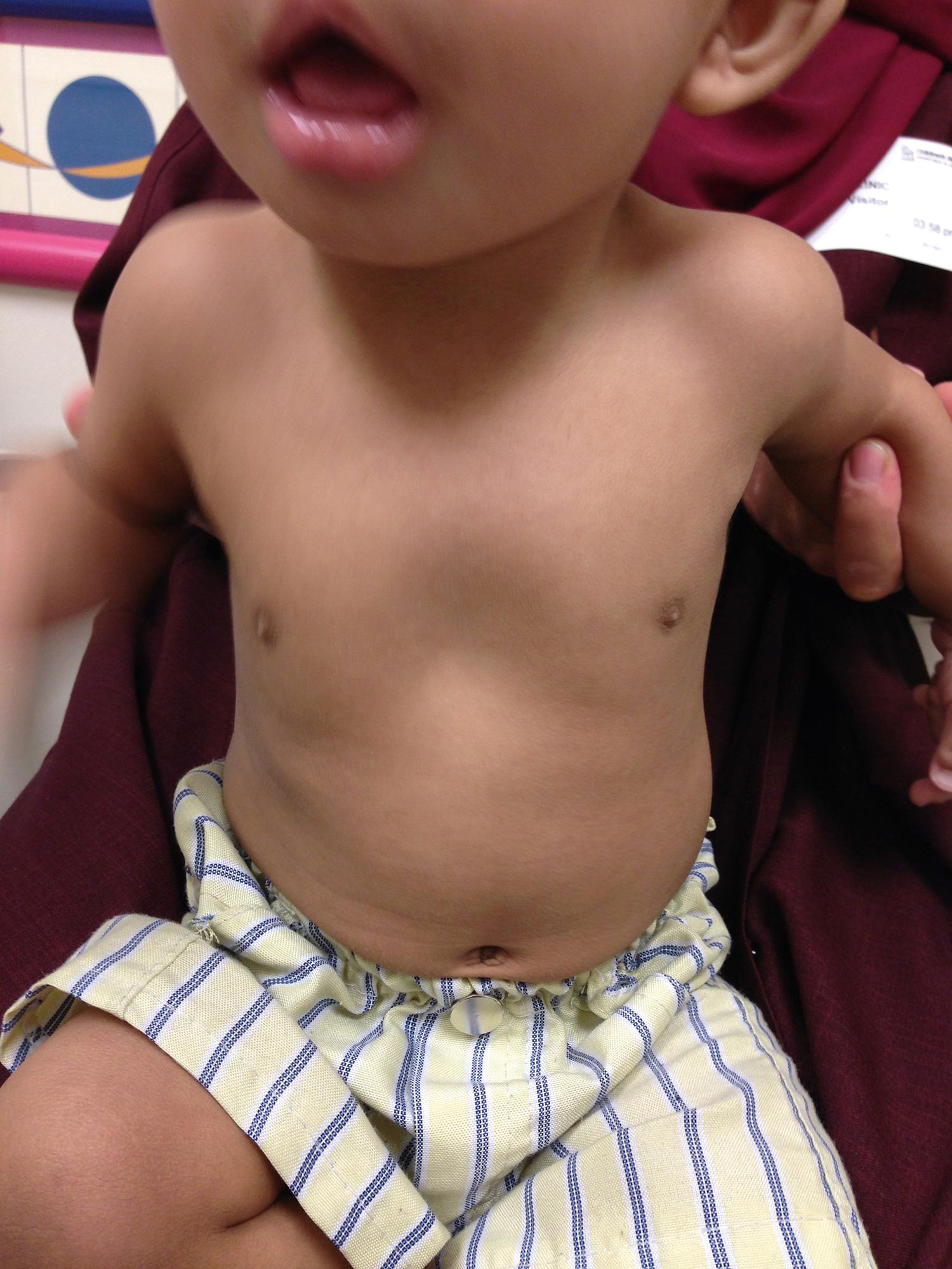 Fig. 20.2, Pectus excavatum is often seen in infants. This 11-month-old child was evaluated for a pectus excavatum. Observation was recommended.