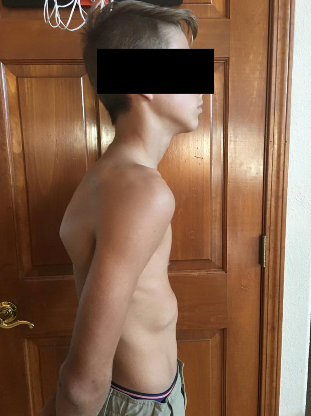 Fig. 20.3, This boy has the classic pectus posture with thoracic kyphosis, forward-sloping shoulders, and lumbar lordosis.