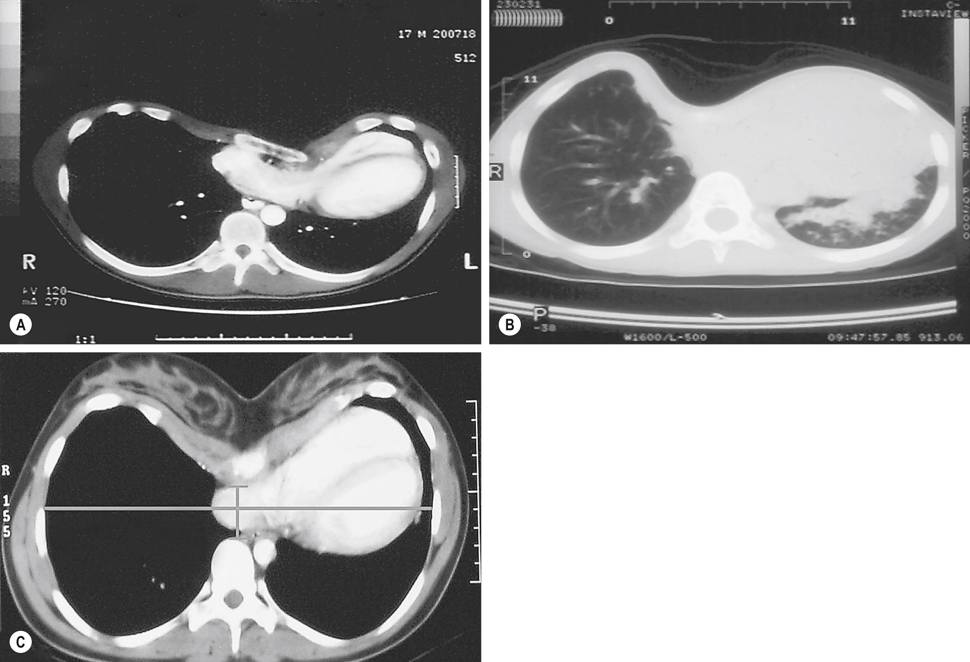 Fig. 20.5, (A) CT scan showing cardiac compression and displacement, pulmonary compression, asymmetry of the chest, and sternal torsion. (B) CT scan showing severe pulmonary compression and atelectasis. (C) CT index is calculated by dividing the transverse diameter by the anteroposterior diameter.