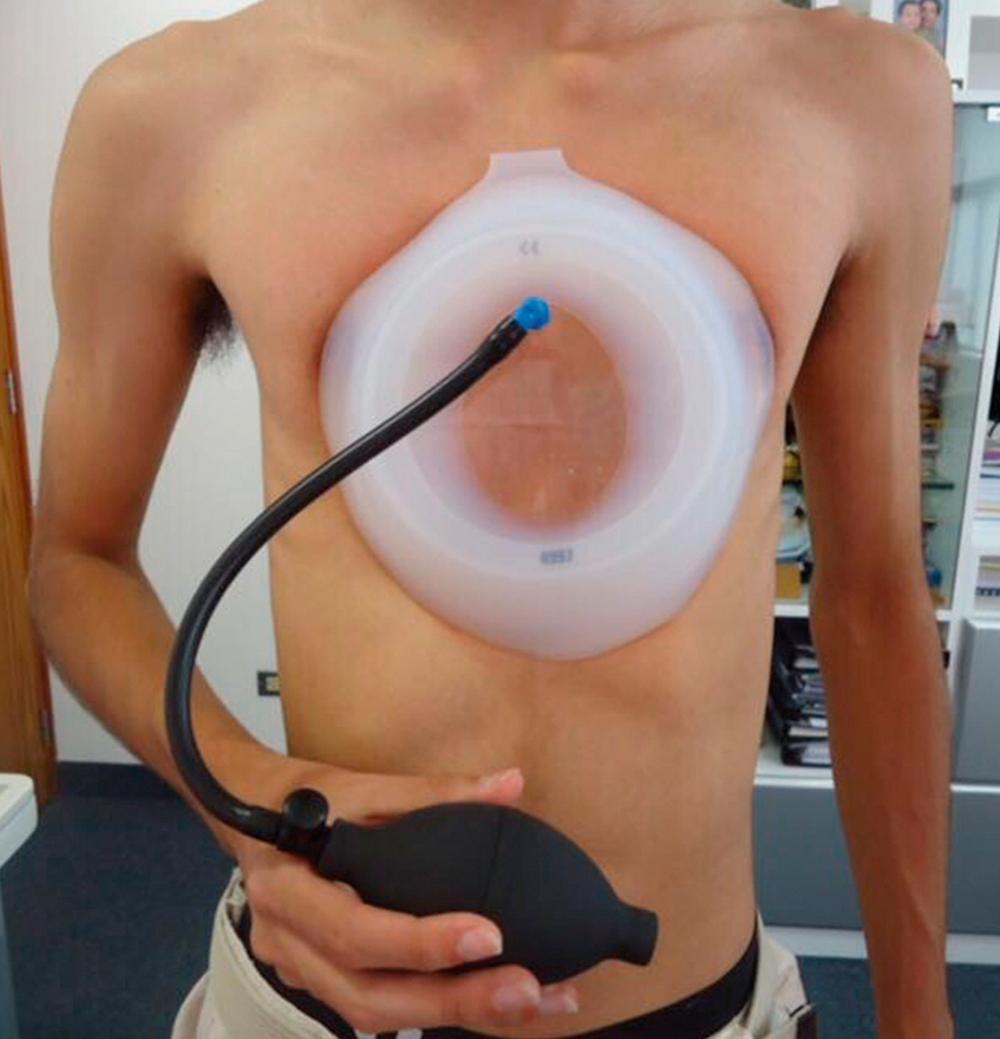Fig. 20.7, This boy is being managed with the vacuum bell, which relies on suction to bring the anterior sternum forward and correct the pectus excavatum. It is being used more internationally than in the United States at this time. (Photograph courtesy Dr. Carlos Segura.)