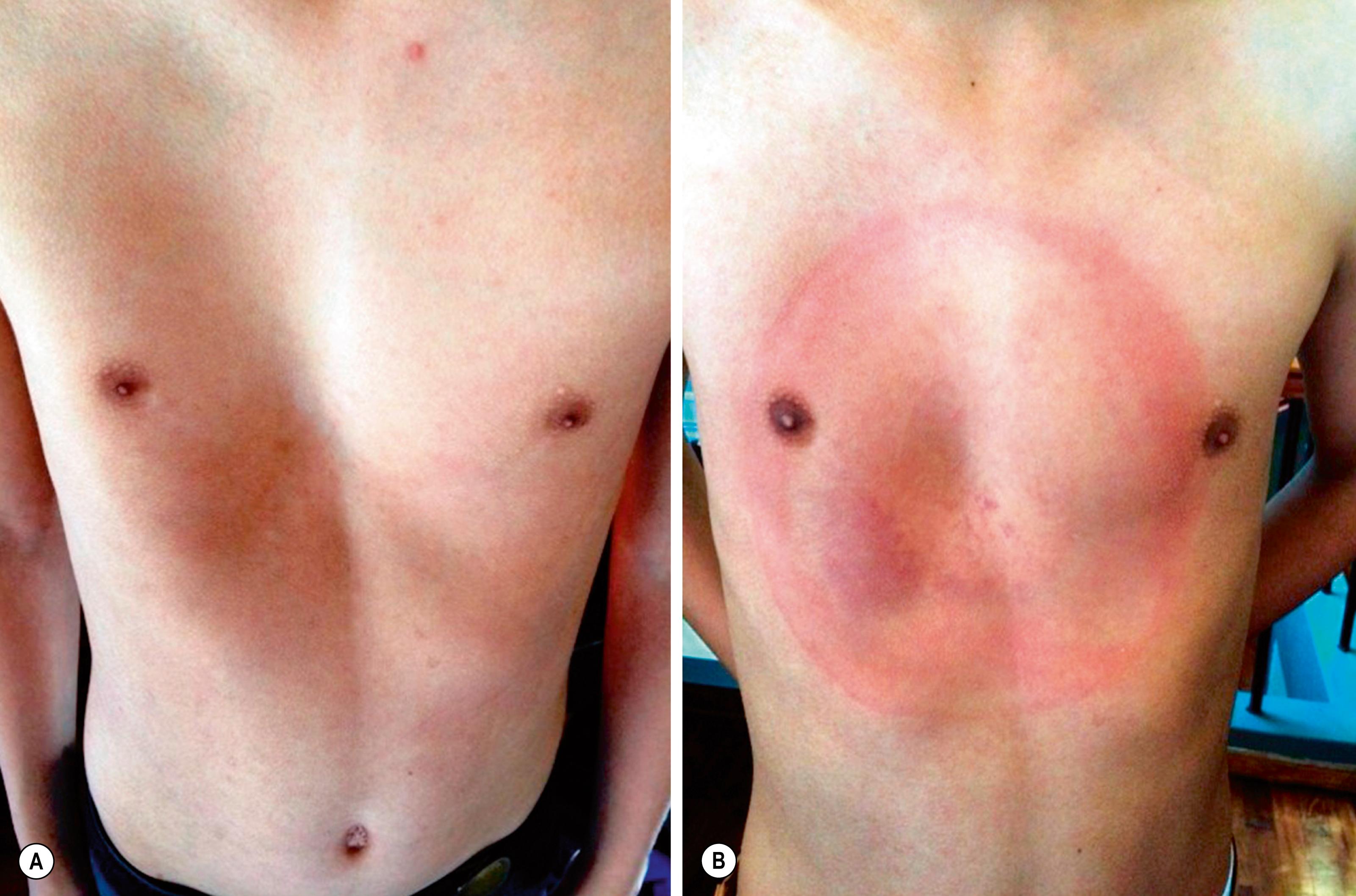 Fig. 20.8, The vacuum bell was used in this child. On the left (A) is the appearance of the chest wall prior to treatment with the vacuum bell. On the right (B) the pectus excavatum is improved following several months use with the vacuum bell. Note the suction marks caused by the vacuum bell on his anterior chest wall. (Photograph courtesy Dr. Carlos Segura.)