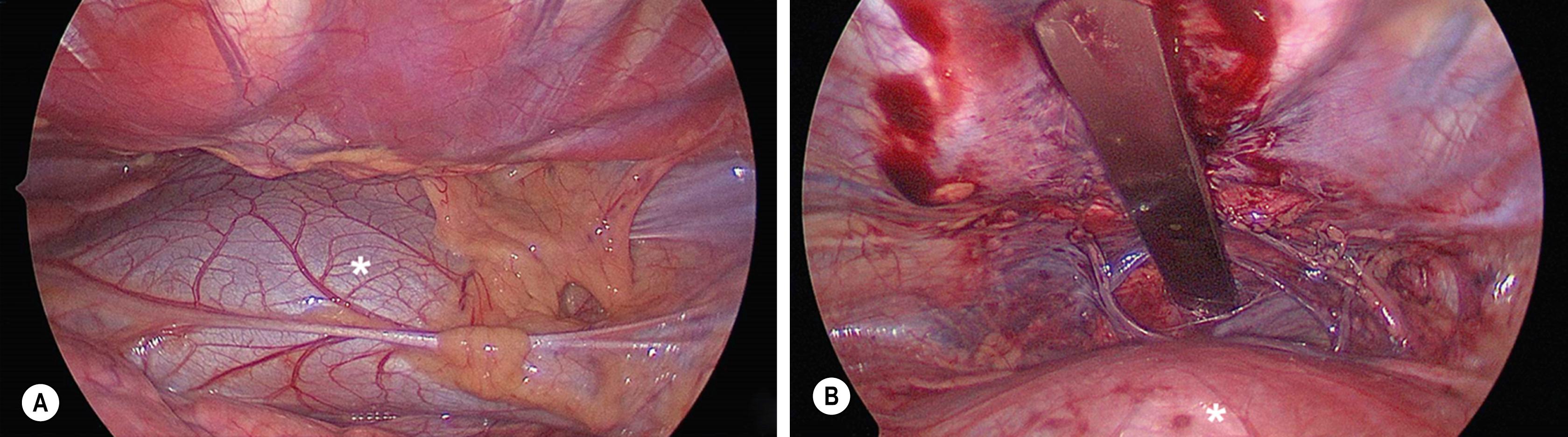 Fig. 20.10, This operative photograph (A) shows the initial view seen by the surgeon when thoracoscopy is used for pectus excavatum repair. The pericardium and heart (asterisk) are abutting the anterior chest wall due to the significant pectus excavatum. In (B), the heart and pericardium (asterisk) have been mobilized posteriorly to allow passage of the bar under the depressed sternum. The sternum has been elevated by the bar, thereby creating much more space between the heart and anterior chest wall.