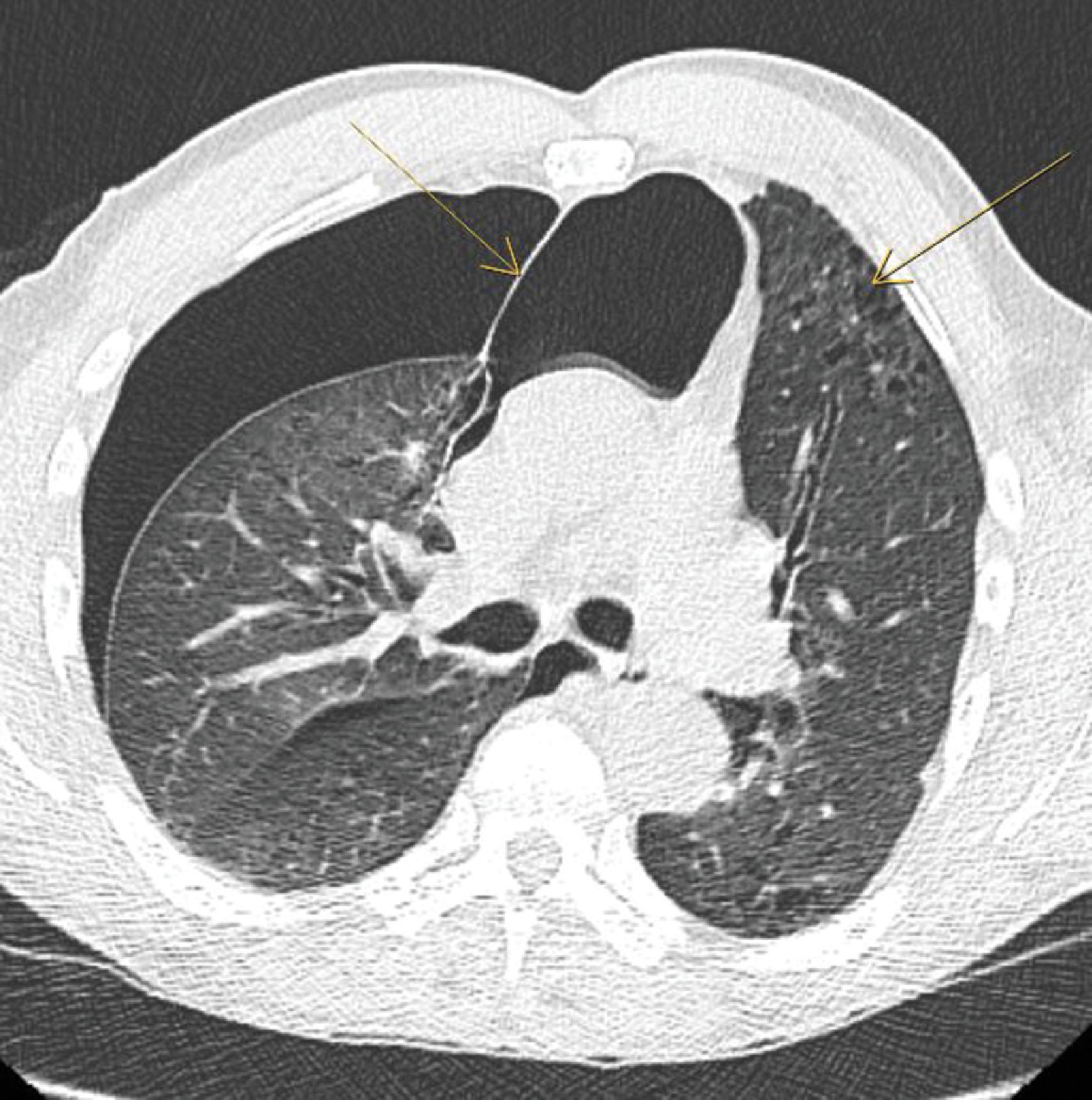 FIG. 2, Axial CT scan of a patient with emphysema ( left arrow ) demonstrating a large bleb protruding from the right upper lobe and displacing the mediastinum (right arrow).