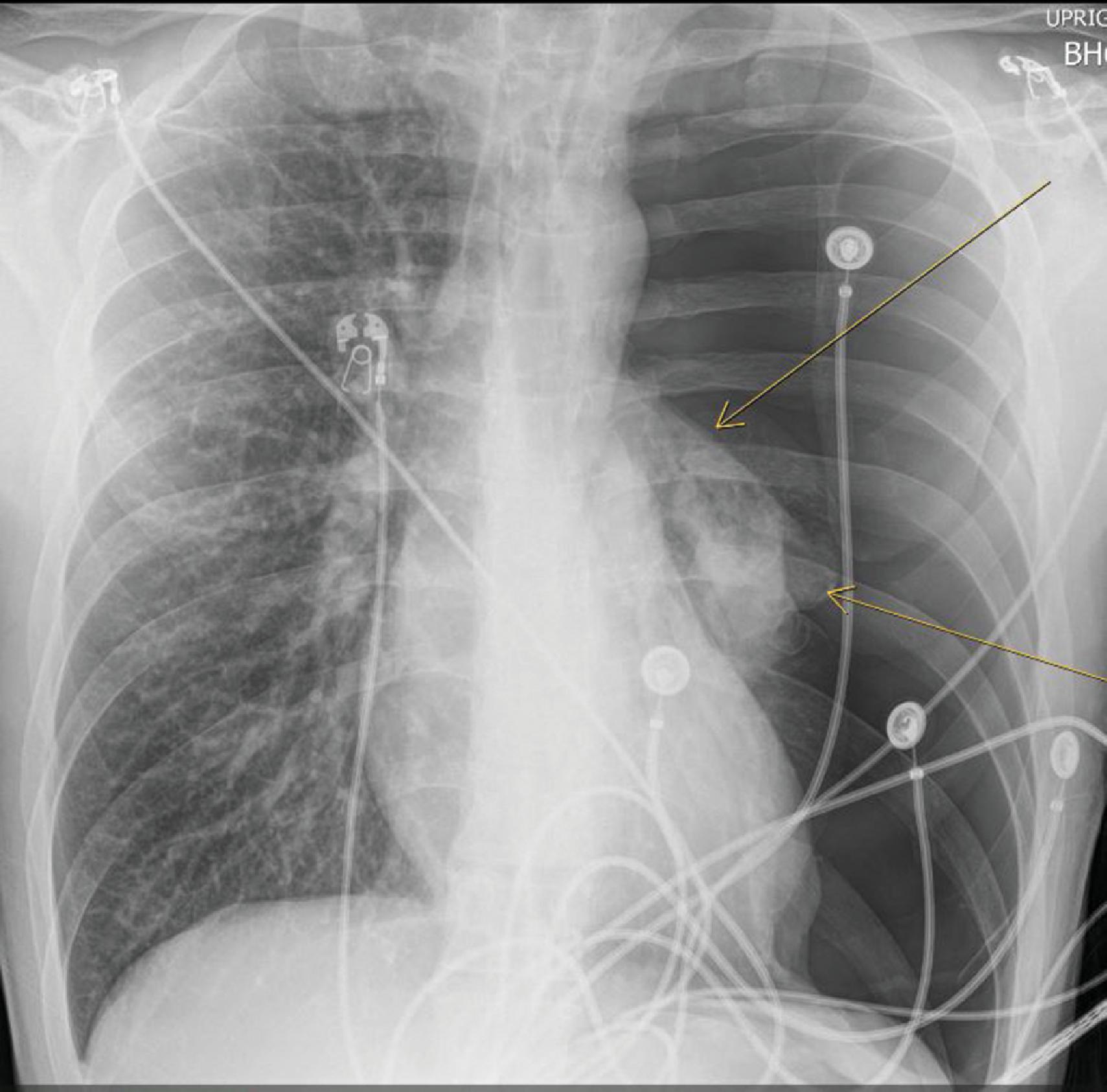 FIG. 3, Chest x-ray demonstrates a large left pneumothorax with complete collapse of the lung and evidence of mild tension with shift of the mediastinum and slight depression of the diaphragm in a patient with a spontaneous pneumothorax.