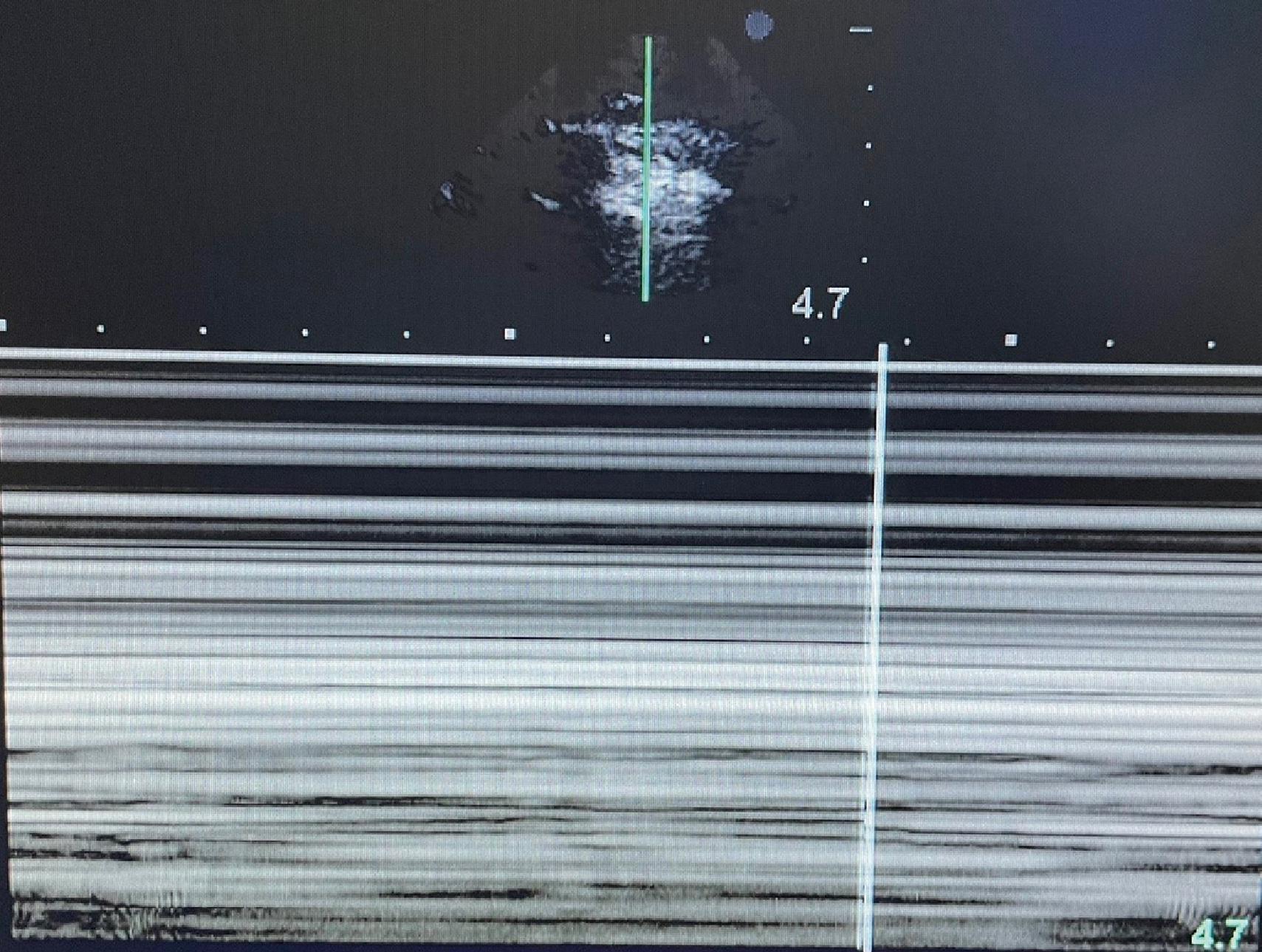 FIG. 5, Pneumothorax in M mode. The separation of the visceral and parietal pleura results in the loss of granular pattern of normal lung. A series of horizontal lines under the pleura are seen instead, also known as the “bar code” sign.