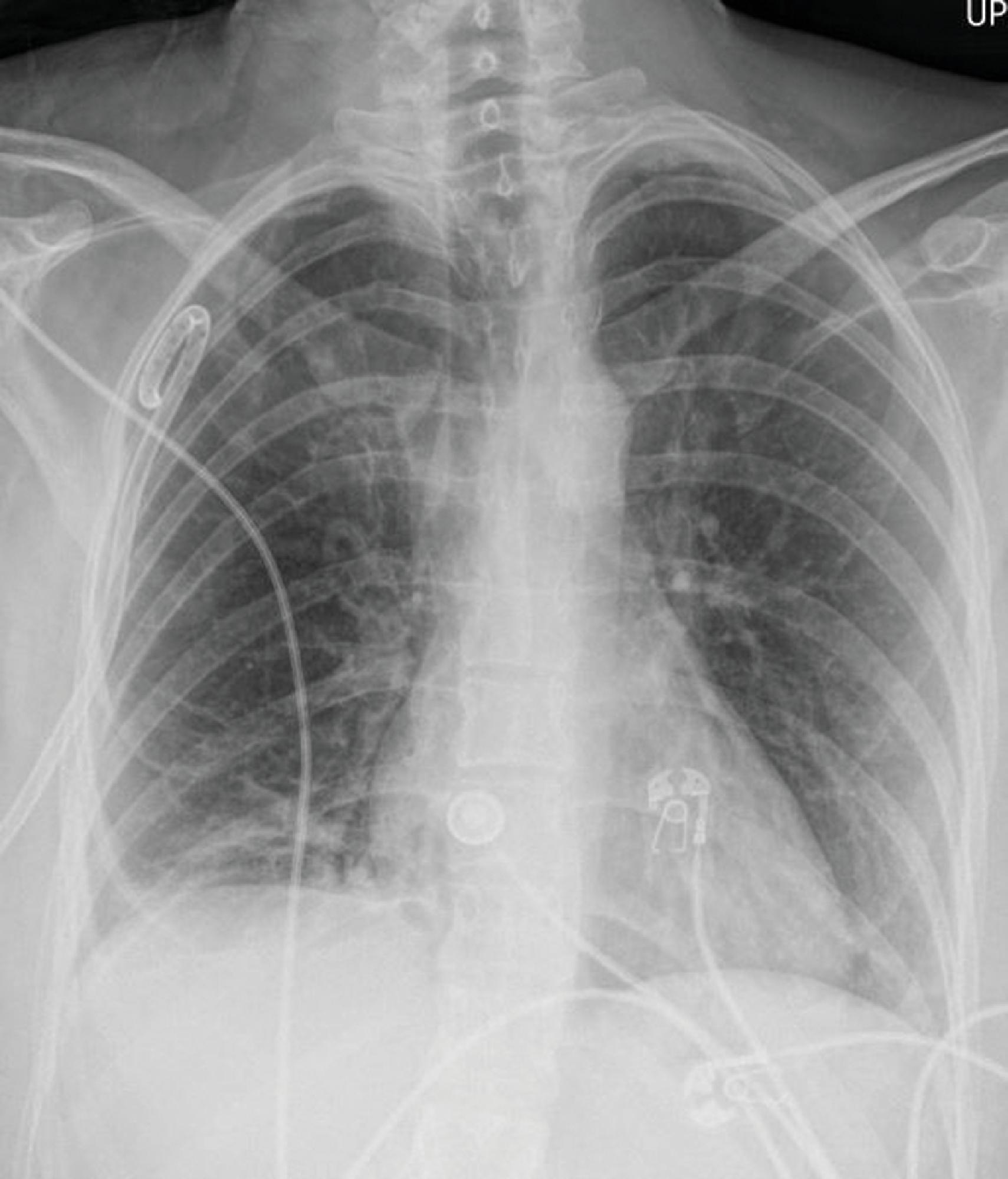 FIG. 6, Chest x-ray demonstrates a well-placed apical left pigtail chest tube catheter to reexpand the lung after a spontaneous pneumothorax.