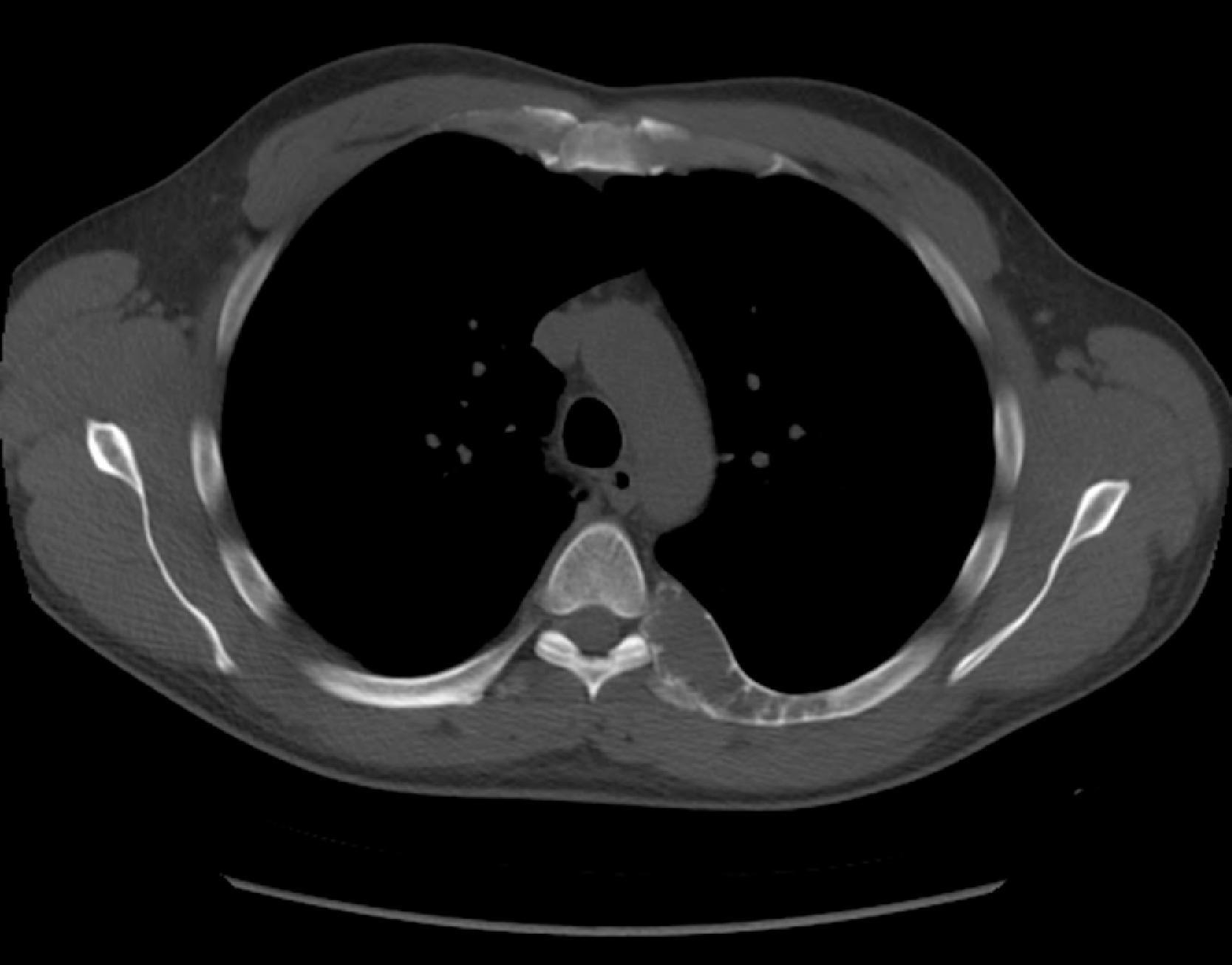 FIG. 1, Chest CT demonstrating fibrous dysplasia of the posterior left sixth rib.