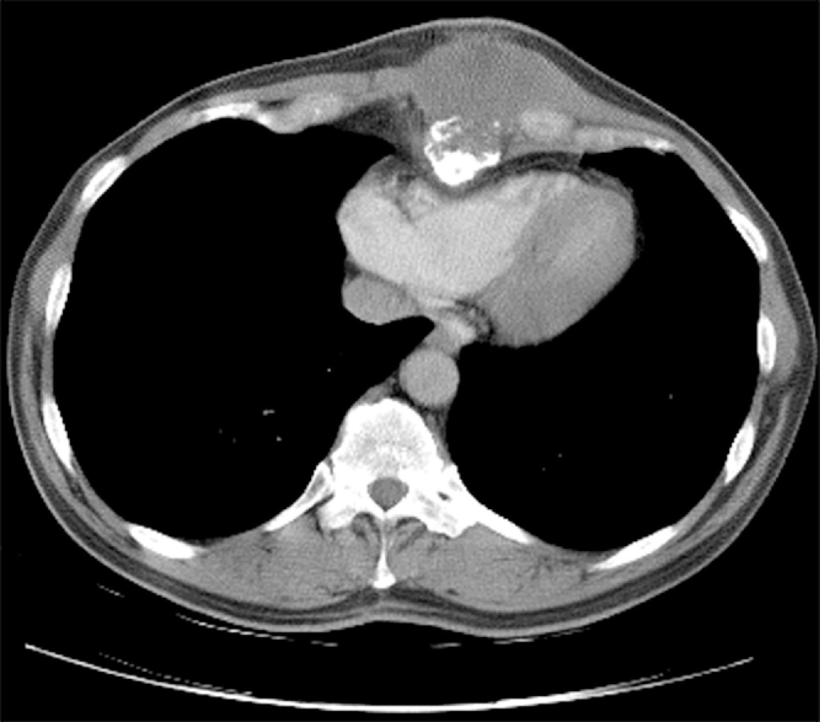 FIG. 2, Chest CT demonstrating a chondrosarcoma of the lower sternum and xyphoid.