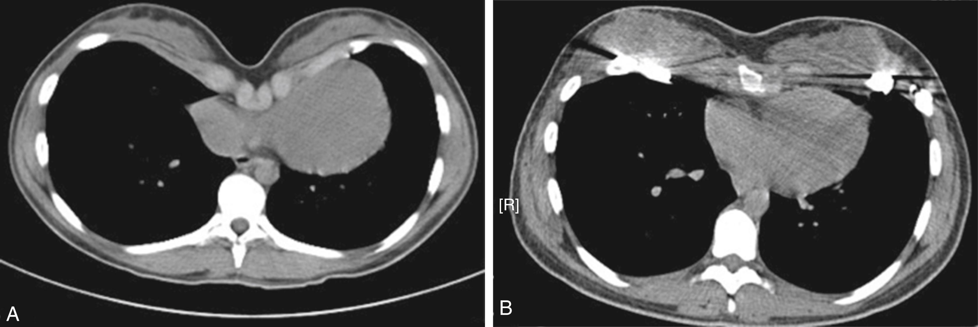 Fig. 39.1, Transverse section of a computerized tomography (CT) scan of a patient with pectus excavatum, (A) before and (B) after Nuss correction. Note the cardiac compression seen before correction.