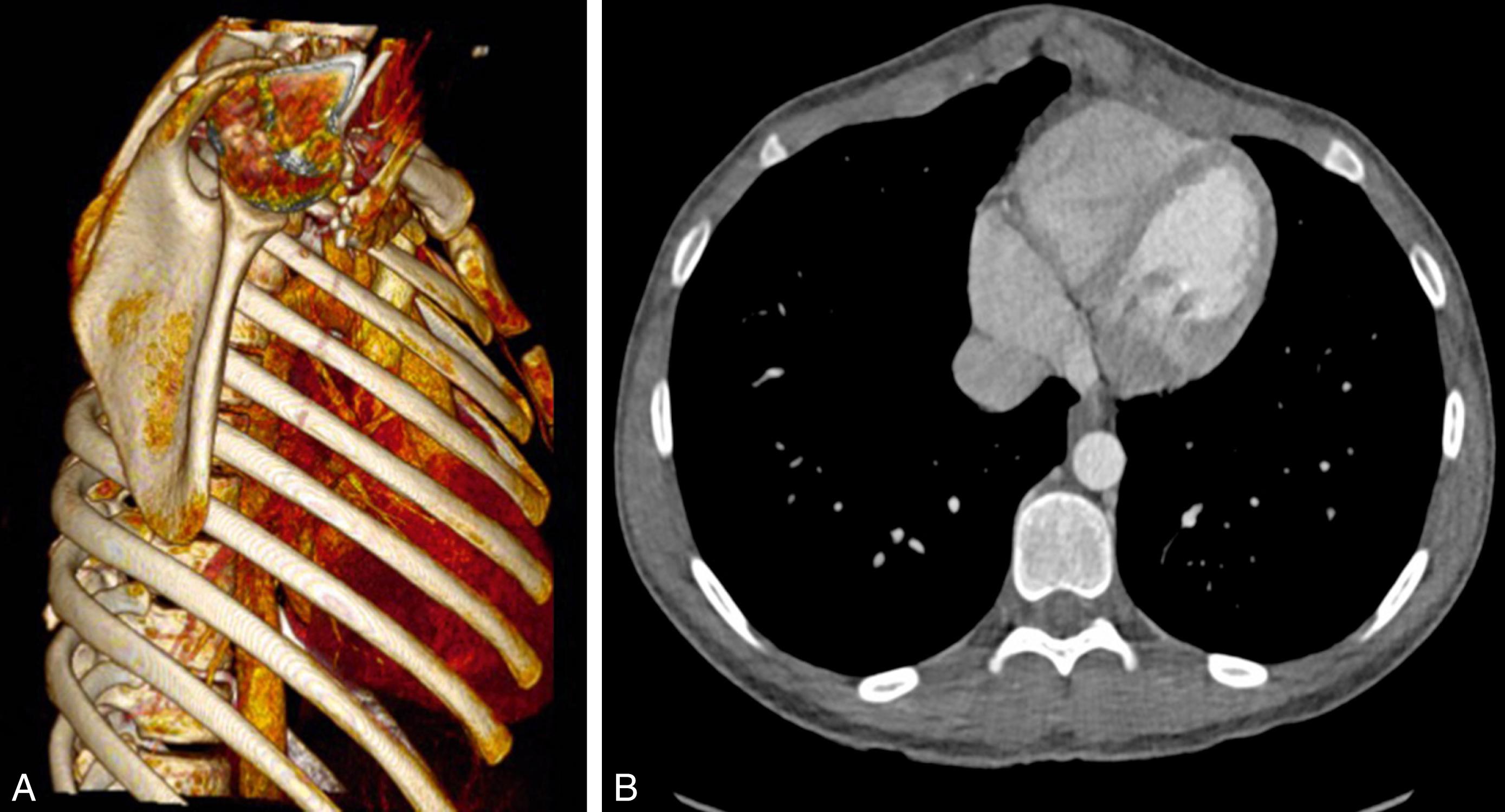 Fig. 39.2, Pectus carinatum as seen on (A) 3D CT reconstruction and (B) transverse CT scan . Note the 90 degree angulation between the body of the sternum and xiphisternum.