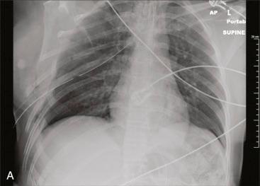 Fig. 50.1, (A) Initial trauma bay radiograph demonstrated flail chest injury on the right side. (B–D) Computed tomography with three-dimensional (3-D) reconstruction demonstrates rib fractures involving ribs 1 through 9 on the right side and ribs 3 and 4 on the left side. (E) Sagittal imaging demonstrates fracture of the sternum with disruption of the sternomanubrial junction. Flail segment includes ribs 3 through 9 on the right side, the sternum, and ribs 3 and 4 on the left side.