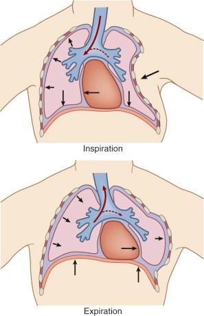 Fig. 50.2, Flail chest produces paradoxical respiration. On inspiration, the flail section moves inward, with mediastinal shift to the uninjured side. On expiration, the flail section bulges outward, with mediastinal shift to the injured side.