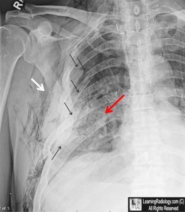 Fig. 50.4, Subcutaneous air is present, as seen in the chest radiograph, and should tip off the examiner to a pneumothorax that requires chest tube placement.