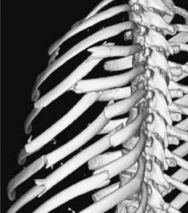 Fig. 50.5, A three-dimensional computed tomography (CT) scan showing a flail chest injury with multiple consecutive segmental fractures. Instability of the chest wall is striking and can lead to paradoxical chest wall motion during ventilation in such cases.