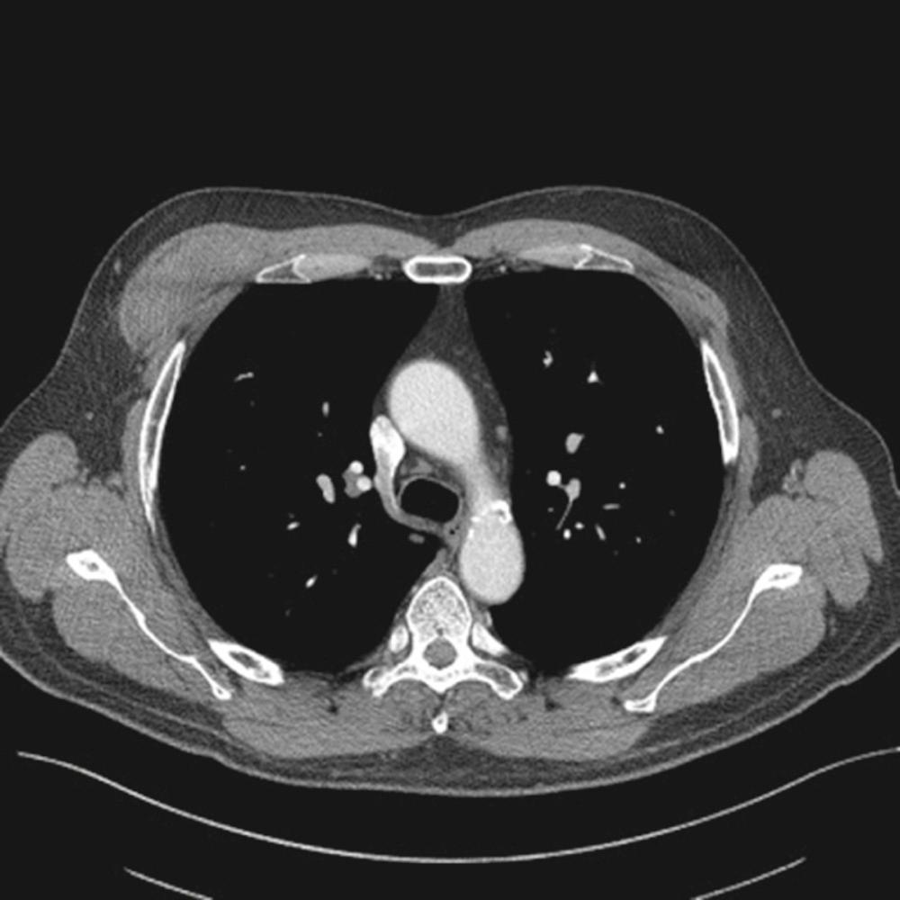 FIGURE 25-1, CT scan of a right anterior chest wall mass.