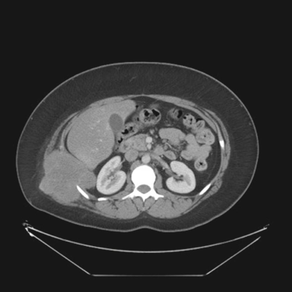 FIGURE 25-2, CT scan of a right posterior Ewing tumor.