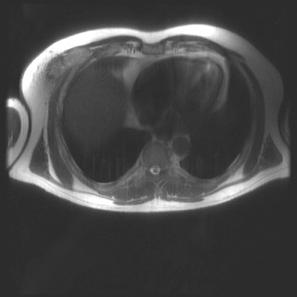 FIGURE 25-3, MRI of the right anterior chest wall mass seen in Figure 25-1 . The MRI is often a better way to delineate the tumor from surrounding tissue.