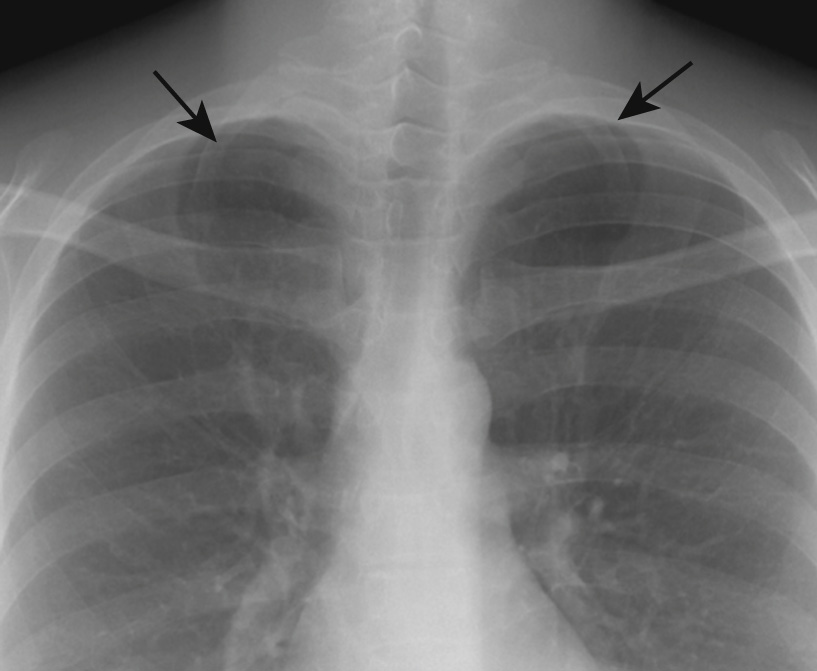 Cervical ribs. Bilateral downsloping cervical ribs (arrows).